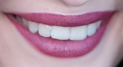 Close the Gap with Minimal Tooth Movement®