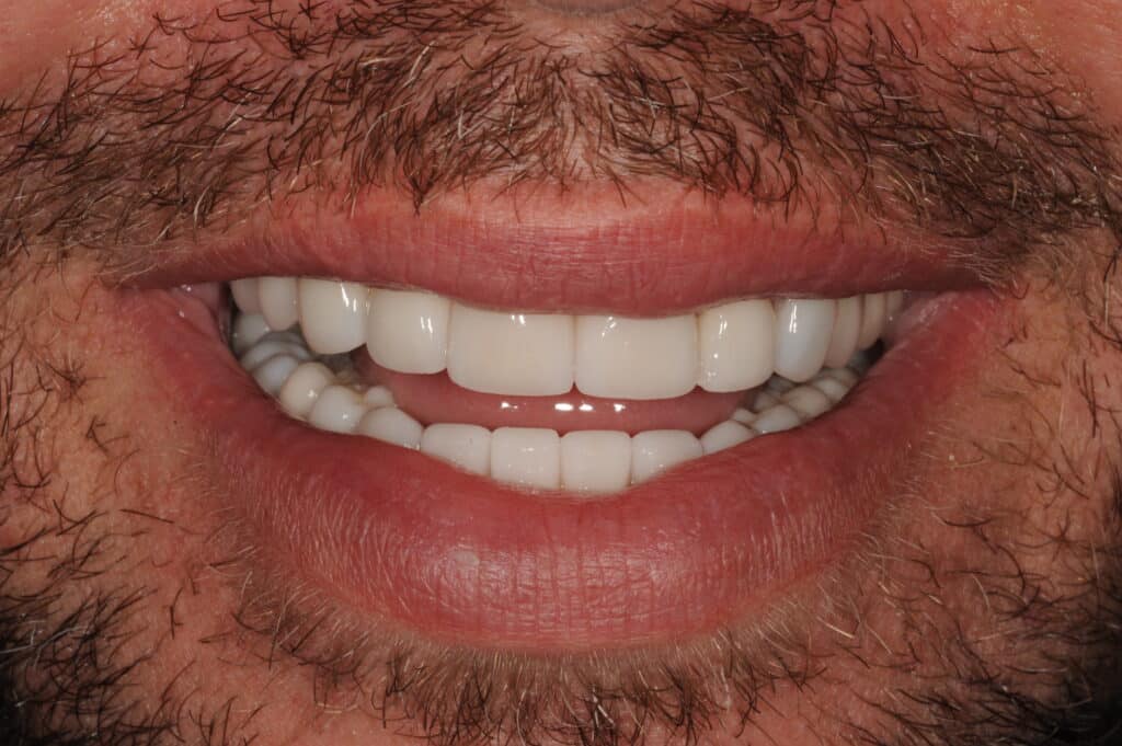 Full Mouth Reconstruction Orange County