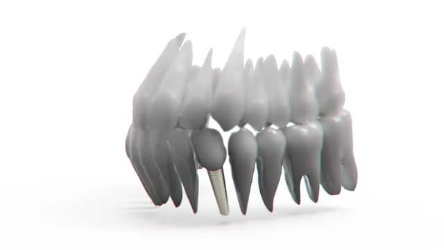 Dental Implants Have Changed Over the Past Twenty Years