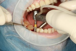 dental _implants_Anaheim_Hills