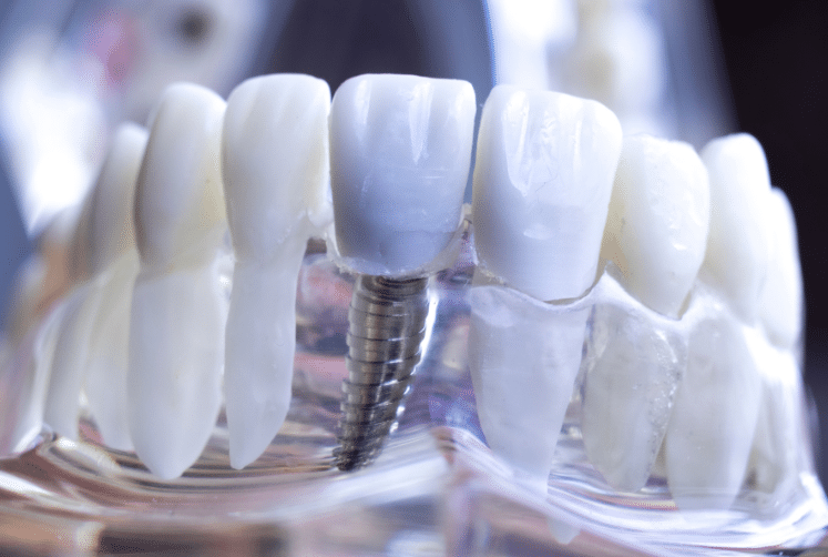 Dental Implants for Confidence and Self-Esteem